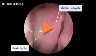 An example of the impact of XHANCE after 6 months of use